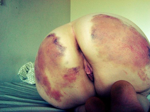 Photo by modificator with the username @modificator,  January 15, 2019 at 12:05 PM and the text says 'Can we call it 'Well done'?
#spanking #bruises #spankingmarks #lovemarks #butt'