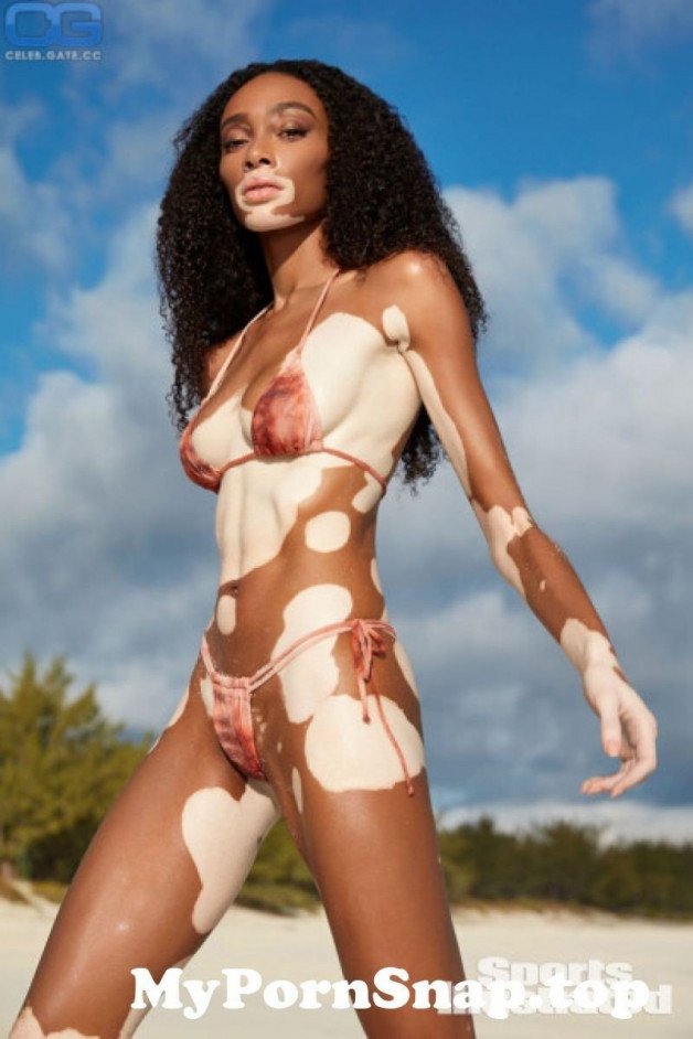 Album by HOSPITABLEFREAK with the username @HOSPITABLEFREAK,  November 15, 2021 at 3:49 AM. The post is about the topic Beauty is in Everyone and the text says 'Vitiligo beauty'