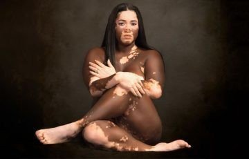 Album by HOSPITABLEFREAK with the username @HOSPITABLEFREAK,  November 15, 2021 at 3:49 AM. The post is about the topic Beauty is in Everyone and the text says 'Vitiligo beauty'