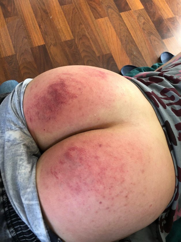 Photo by YourSpanker with the username @Onlyspanks, who is a verified user,  August 16, 2022 at 7:24 PM. The post is about the topic Only Spanks and the text says 'A deep glow that should blossom into pretty marks and it looks like it should have been effective 🥵🔴🍑  #daddy #spanking #spanker #spankee #slap #slapass #ass #redass #onlyspanks #discipline #otk'