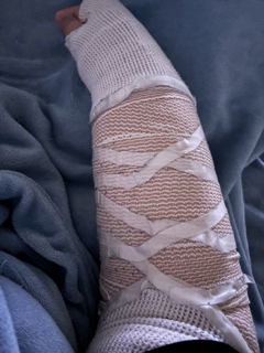 Photo by lilimariexx with the username @lilimariexx, who is a star user,  June 5, 2024 at 9:50 AM and the text says 'broke my arm in two places almost 2 weeks ago eventually will come back, but not right now. hopefully getting my cast on soon I just currently have the splint on'