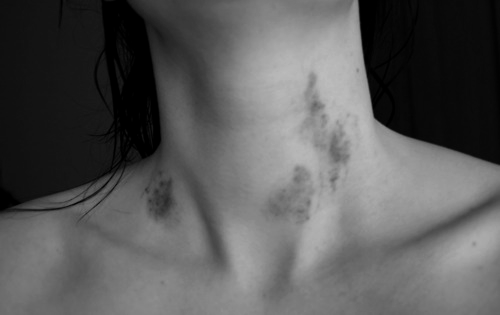 Photo by smutch with the username @smutch,  August 16, 2011 at 5:58 PM and the text says '#bnw  #photos  #bruises  #marked'