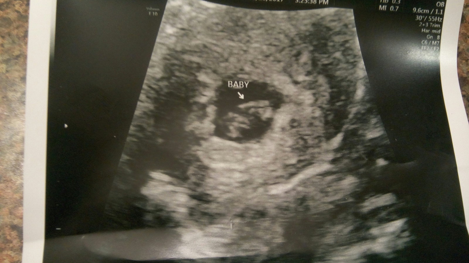 Watch the Photo by Babyji~Queen with the username @BabyjiQueen, posted on January 26, 2017 and the text says 'There was so much crying in that office yesterday. Every thing is perfect so far and I am completely over the moon about it. I can’t wait to meet this little angel.

 #Me  #Mybebe  #155bpm'
