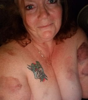Photo by Alaina subby SlutPSO with the username @AlainaPSO, who is a verified user,  September 8, 2019 at 5:33 PM and the text says 'All my lovely bite marks from C.O.P.E. (Central OH Perversion Excursion)!'