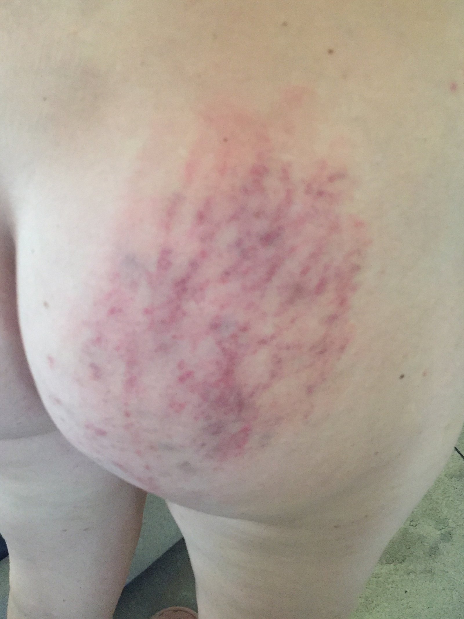 Photo by NaughtybutNice with the username @NaughtybutNice,  June 13, 2020 at 11:25 PM. The post is about the topic MILF and the text says 'I must have been a naughty girl because I got a flogging last night. Here are some during and morning after pictures of the result of my punishment.... #slut #amateur #MILF #flogging #bruises #BDSM #ass'