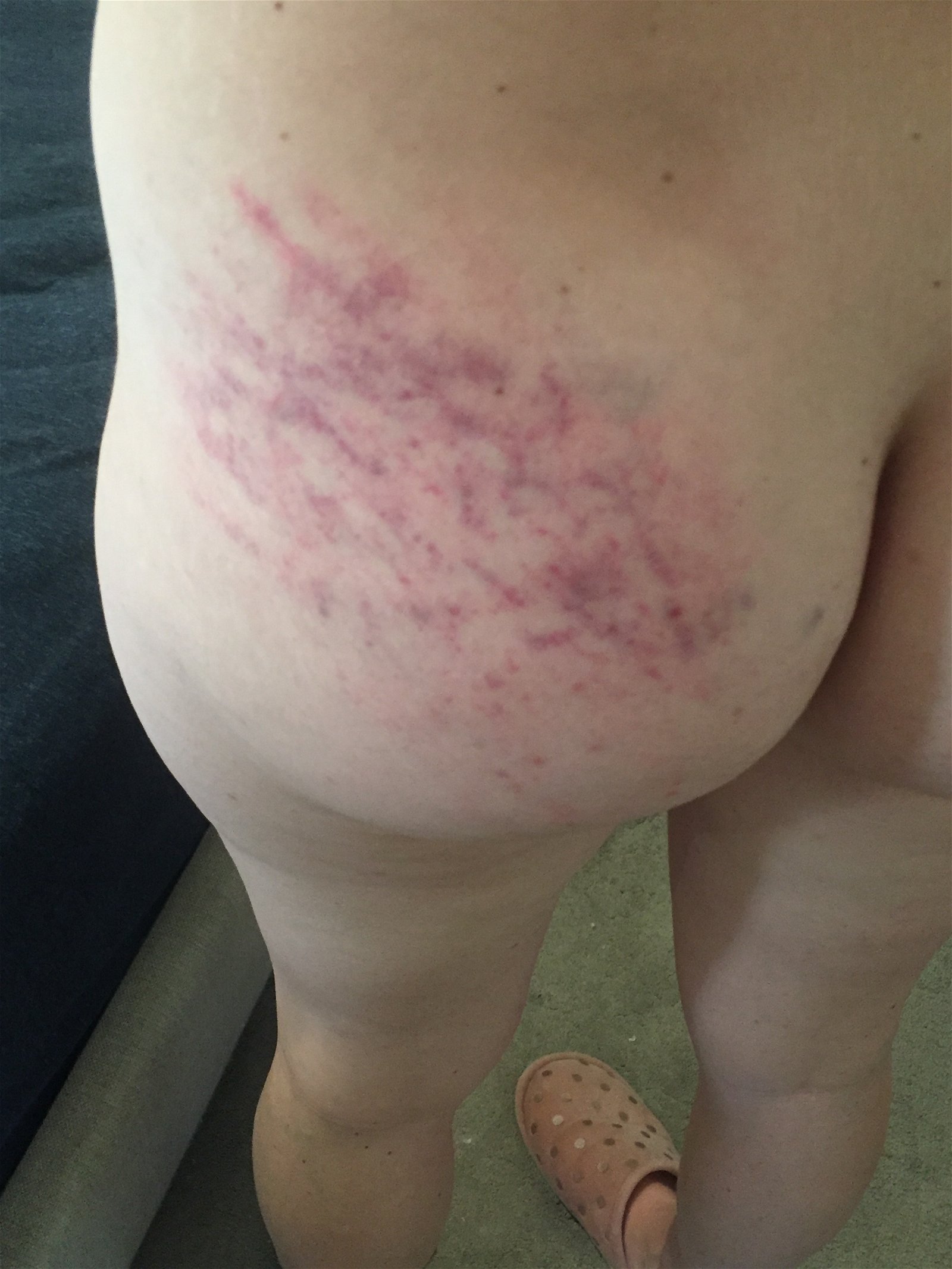 Photo by NaughtybutNice with the username @NaughtybutNice,  June 13, 2020 at 11:25 PM. The post is about the topic MILF and the text says 'I must have been a naughty girl because I got a flogging last night. Here are some during and morning after pictures of the result of my punishment.... #slut #amateur #MILF #flogging #bruises #BDSM #ass'