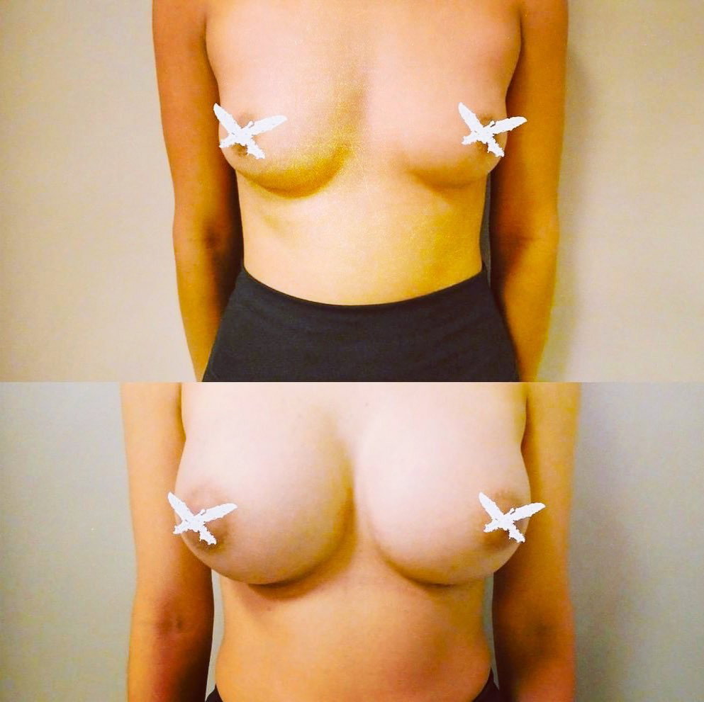 Watch the Photo by s ziru with the username @Ziru69, posted on March 28, 2020 and the text says 'talking about before and after!! #breastimplants #hrt #intersex #boobs'
