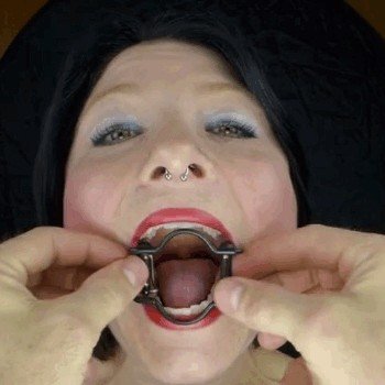 Photo by therapist with the username @therapist, who is a verified user,  March 7, 2018 at 1:30 AM and the text says 'This is the MouthLock. It’s an exceptionally designed and handmade device that perfectly prevents the mouth from closing while leaving a clear path to the throat. I am one of the few people in the world who own this device'