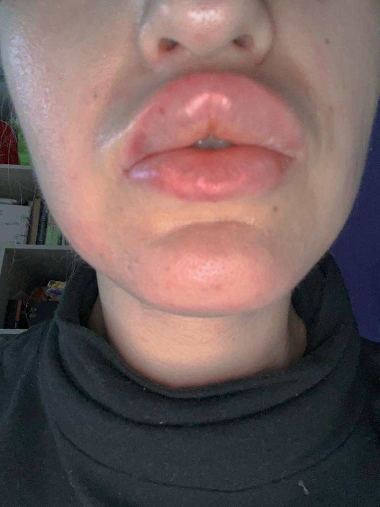 Photo by FinDom Goaldigger with the username @findomgoaldigger, who is a star user,  October 31, 2022 at 11:51 AM and the text says 'Lip Fillers Donation Target for BIG LIPS LOVERS! Pay for my fillers in my lips what I did this Friday! 28.10.2022 It cost 400$ #lipsfetish #biglips #fulllips TIP IN ONLYFANS OR  LOYALFANS + manyvids, clips4sale, iwantclips'